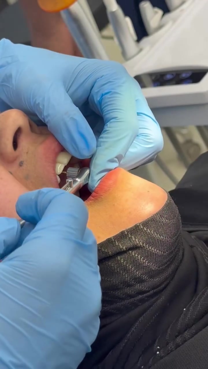 🦷 زراعة أسنان — الدكتورة ندى صفاء الدين

🔹 تعويض الأسنان المفقودة

🔹 تحسين الشكل والابتسامة

🔹 زراعة بأحدث التقنيات الطبية

📍 طوز — شارع الأطباء — مقابل حسينية أسد الله

📞 للحجز: ‭0770 953 3629‬
