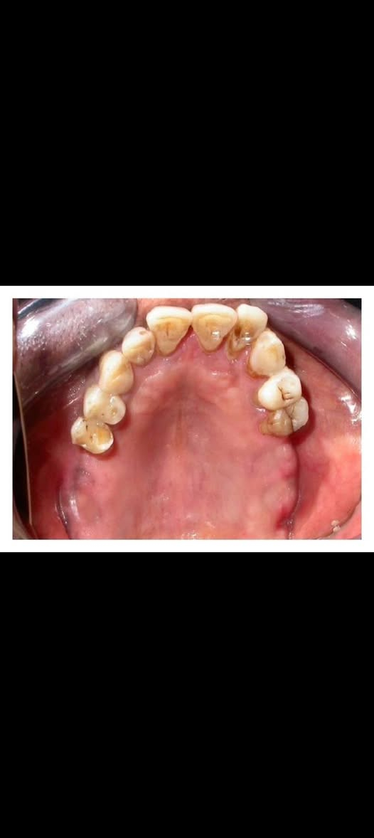 السلام عليكم اللي فاقد اسنانة مثل الي بالصورة ويريد يعوضهم بطقم متحرك مجاني يتواصل واتساب  ***********
جامعة الهادي نهاية شارع ستين قرب كنيسة بولص وبطرس
