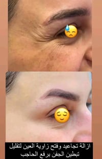 كريم بديل الفلر • شد البشرة • بدون إبر