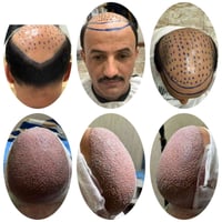 عملية بنفس اليوم ✨  رغم إنو المنطقة المانحة ضعيفة،   گدرنا نوصل لنتيجة...