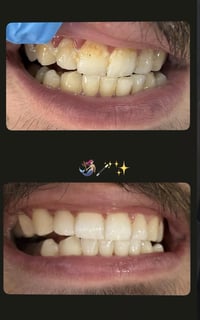 تنظيف أسنان • مجاني • موصل شلالات