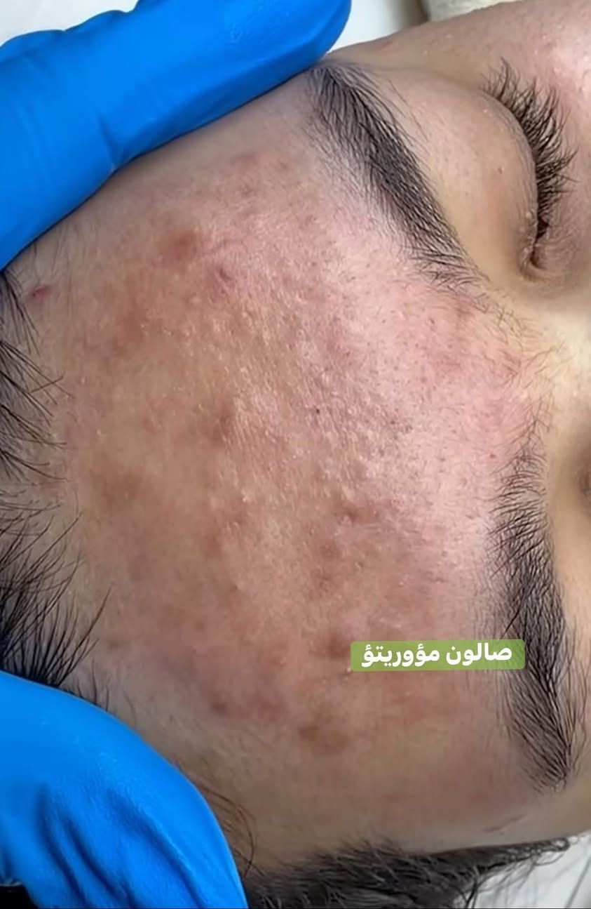 لاتخلي. بشرتك حقل تجارب 🧏🏿🧏🏻
اقوى واحدث الجلسات العالميه 🌍
ازاله الرؤؤس السوداء ومعالجتها ☑️
ازاله الدهون.   وتقليص المسام 👨🏻‍⚕️

للحجز مرسله الحساب اوالاتصال 
***********📞
العنوان. ناصريه قضاء النصر. خلف مستوصف الزهراء
