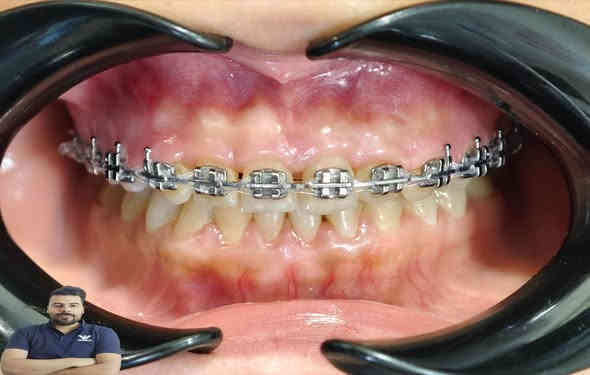 تعديل الاسنان الامامية باستخدام التقويم المعدني 

العنوان / المسيب / شارع البلدية / مقابل دكتور جعفر وفي للاطفال

للحجز والاستفسار
***********
***********
