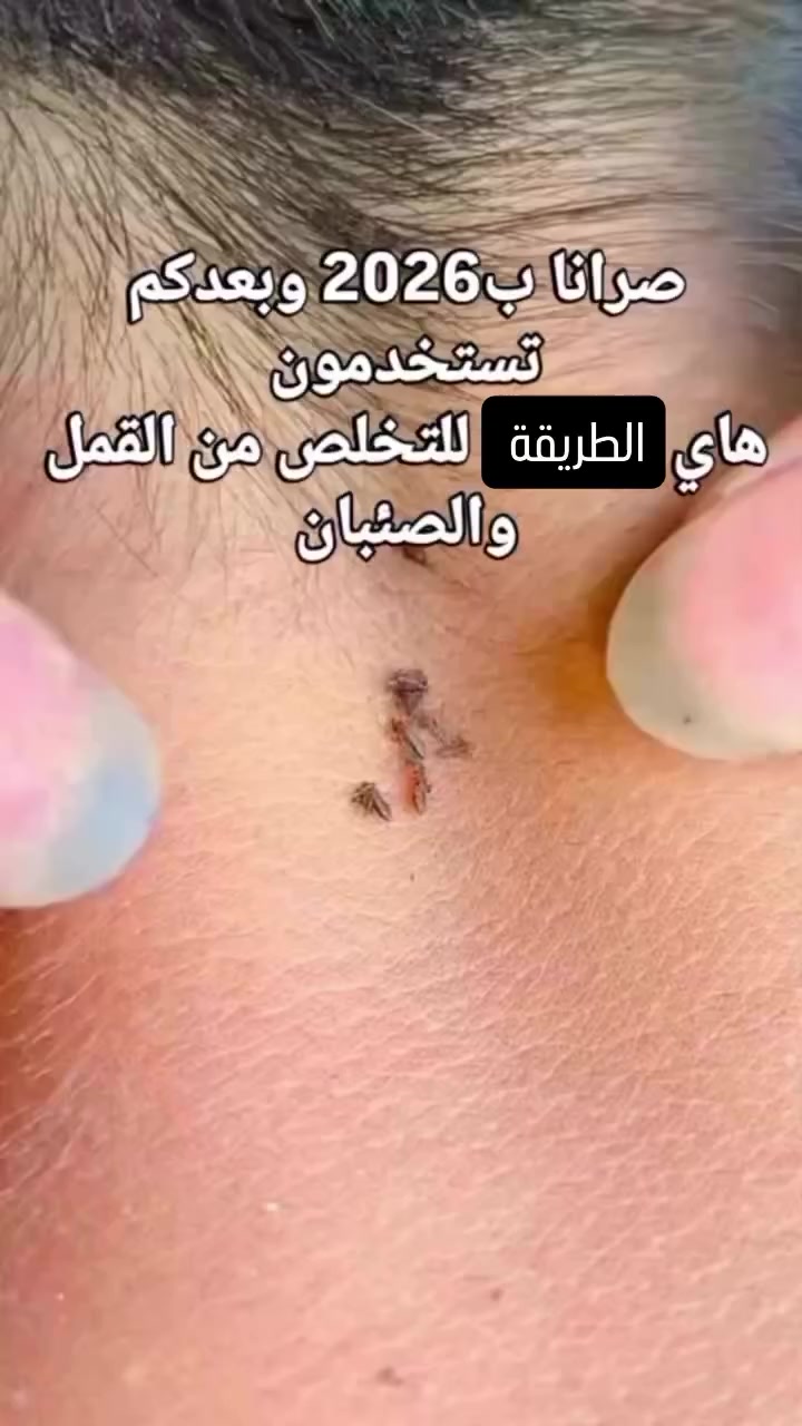 جهاز ازالة القمل الكهربائي راح يغنيج عن كل الطرق ويشيل القمل بكل سهولة وبدون أي تعب 👌🏻✅.

#جهاز_القمل_الكهربائي #جهاز_القمل_الكهربائي #في_كومب


**إذا كنت صاحب هذا الإعلان وتريد حذفه لأي سبب، رجاءا أرسل رسالة إلى الدعم الفني**