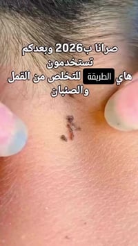 جهاز قمل • كهربائي • بدون تعب