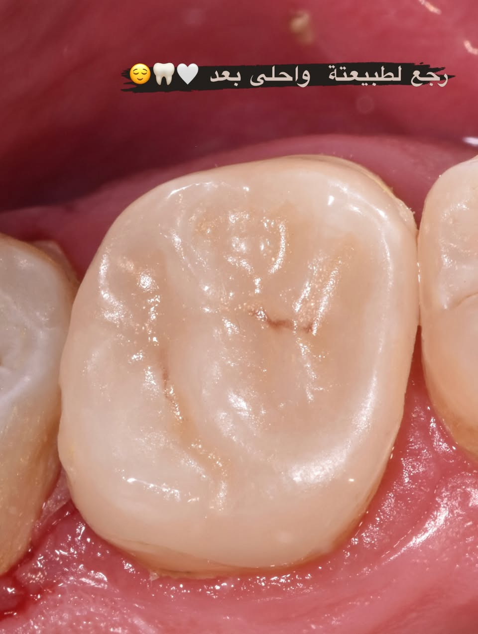 حشوة مختبرية 🦷🪄🫧🌸
.
.
.
.
#حشوة_مختبرية #حشوة_ضوئية #ابتسامتك_أجمل #ابتسامة_طبيعية #صحةالأسنان


**إذا كنت صاحب هذا الإعلان وتريد حذفه لأي سبب، رجاءا أرسل رسالة إلى الدعم الفني**