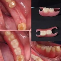 تقدم عيادات جامعة الصفوه خدماتها المجانيه قلع اسنان تالفه وجذور وتعويض...