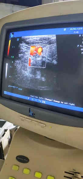 تحية طيبة
يتوفر سونار نوع mindray Dc6 بروب واحد liner
صورتة جدا ممتازة
انتاج 2014
وبسعر جدا جدا مناسب 💥💥💥
للاستفسار واتس اب ***********
او ارسال رسالة على الخاص
#سونار #ايكو #لينير #thiroid #crt #msk #caroted #sup #abdomin #bawoul
