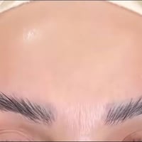 بوتوكس • رفع حواجب • تخفيضات