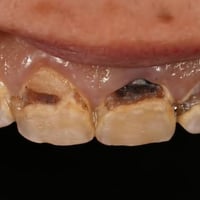 تتوقع اسنانك ما الهن حل ؟  بعيادتنا اغلب المراجعين الي يزورونا يتوقعون...