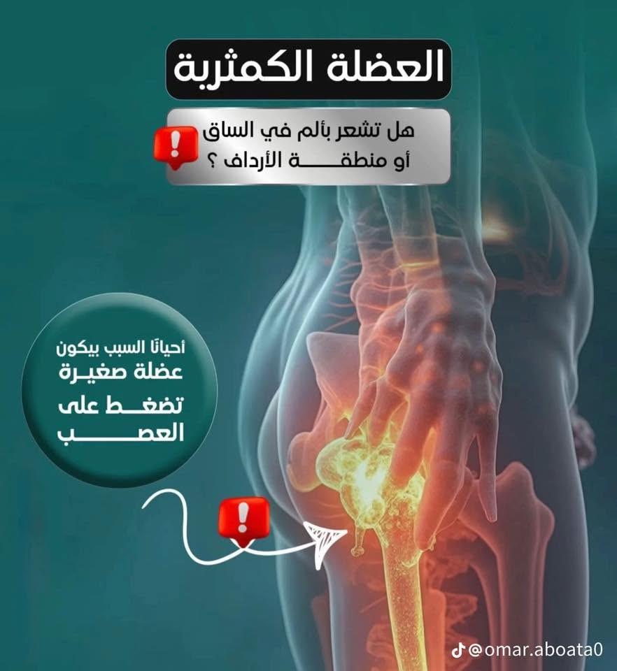 متلازمة العضلة الكمثرية (Piriformis Syndrome)

تُعد العضلة الكمثرية من العضلات الصغيرة الموجودة في منطقة الأرداف، وتقع بالقرب من العصب الوركي (عرق النسا). عند حدوث تشنج أو التهاب في هذه العضلة قد تضغط على العصب الوركي، مما يسبب الألم والتنميل الممتد من أسفل الظهر أو الأرداف إلى الساق.

الأعراض

• ألم في منطقة الأرداف.
• تنميل أو وخز يمتد إلى الساق.
• صعوبة في الجلوس لفترات طويلة.
• زيادة الألم عند المشي أو صعود الدرج.

العلاج

في عيادة الكوثر للعلاج الطبيعي يتم تقييم الحالة ووضع خطة علاج مناسبة تشمل:
• جلسات العلاج الطبيعي.
• تمارين الإطالة وتقوية العضلات.
• العلاج اليدوي.
• الحجامة العلاجية عند الحاجة.
• الإرشادات الوقائية لتجنب عودة الألم.

📍 #عيادة الكوثر للعلاج الطبيعي والحجامة
📞 #***********او 
📍 #الخالدية – #بداية #شارع #أبوفليس – #مجاورصيدليةنارنج 
#الخالديه_رمادي_حديثه_فلوجه_هيت_القائم_بغداد

صحتكم أمانة، والعلاج المبكر يساعد على سرعة الشفاء والعودة للحياة الطبيعية
