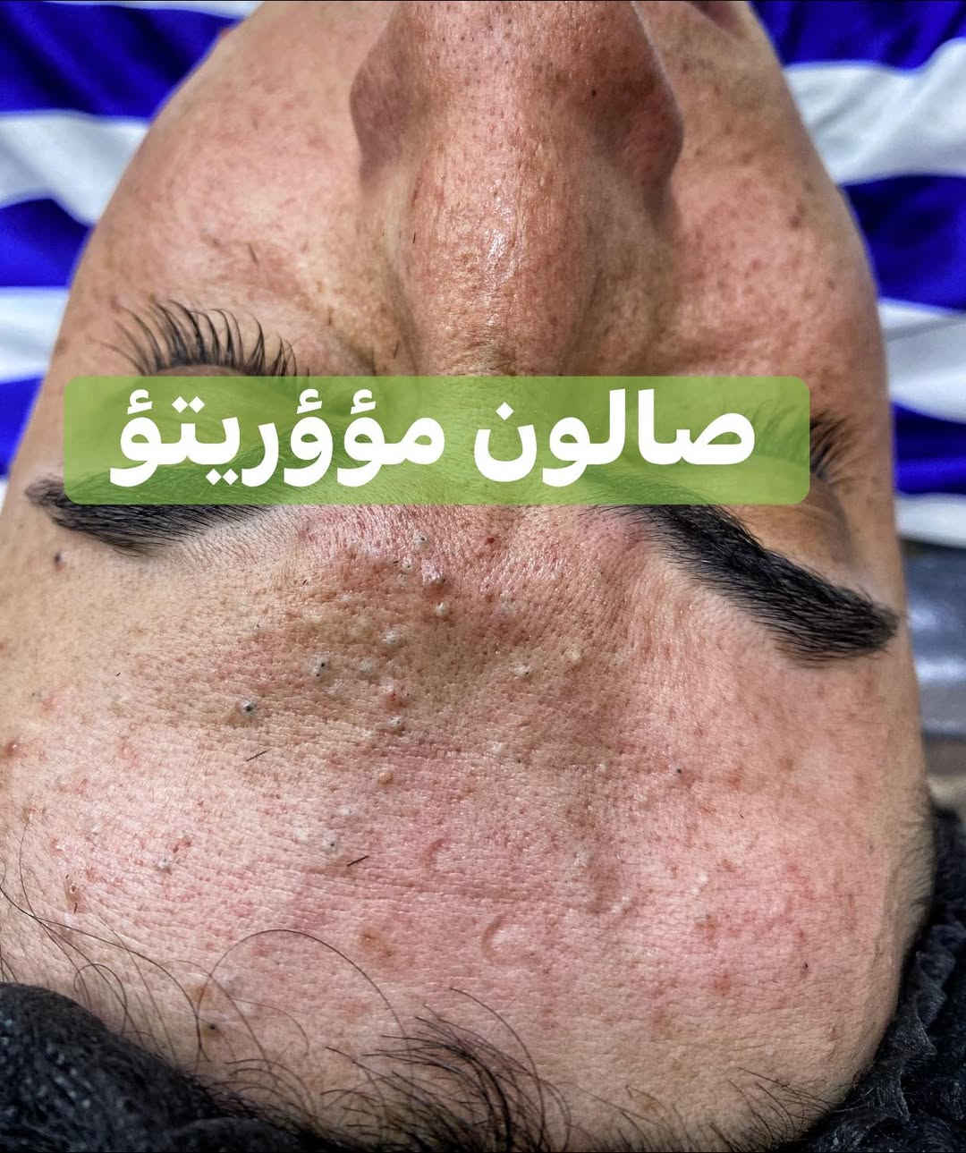 لاتخلي. بشرتك حقل تجارب 🧏🏿🧏🏻
اقوى واحدث الجلسات العالميه 🌍
ازاله الرؤؤس السوداء ومعالجتها ☑️
ازاله الدهون.   وتقليص المسام 👨🏻‍⚕️

للحجز مرسله الحساب اوالاتصال 
***********📞
العنوان. ناصريه قضاء النصر. خلف مستوصف الزهراء

