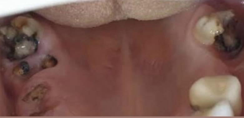 السلام عليكم
الي عنده بقايا جذور اسنان او اسنان تالفة محتاجة قلع

او تنظيف اسنان او حشوات ضوئية تجميلية 

مثل الحالات الي بالصوره 

يكدر يتواصل وياي على الواتساب ***********

 ونحدد موعد الشغل 

العنوان الحلة شارع اربعين مجاور صيدلية سلامتك اولاً
