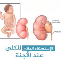 توسع حوض الكلية الولادي ( الاستسقاء الكلوي ) 👶💧  توسع حوض الكلية عند ا...