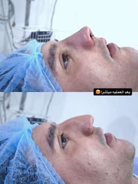 تجميل الأنف • راينوبلاستي • الشطرة