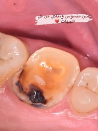 حشوة مختبرية • حشوة ضوئية • حشوة أسنان • تجميل أسنان • صحة الأسنان • ا...