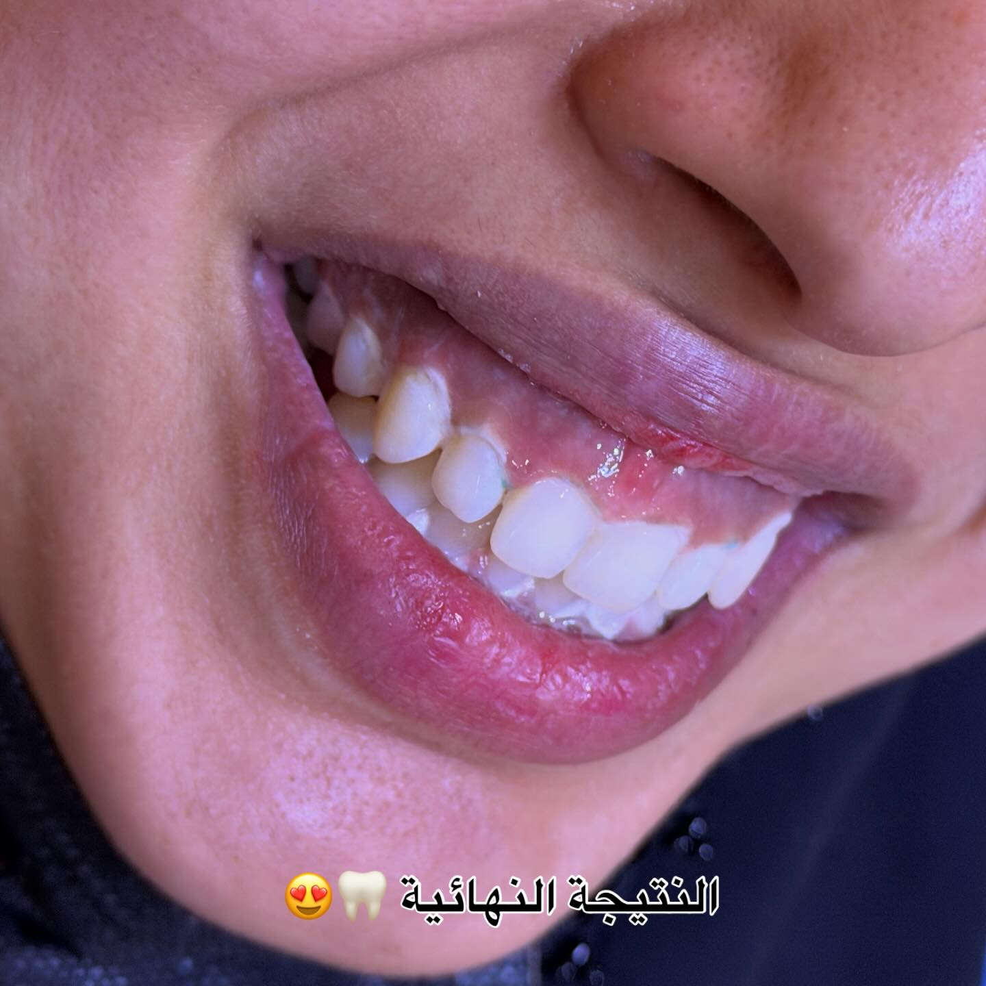 ⁨ شوفو جلسة التبييض 🦷😍 الدكتورة بتول عمار المرمضي 
📍📍عيادة بيرلي (نبتون)
الحمزة الشرقي جهة شارع الملاحة مقابيل صيدلية نجلاء الشيباني 
واتساب او الاستفسار ***********
#الحمزة_الشرقي #الديوانية #الحمزه_الشرقي #عيادة_بيرلي_نبتون #فلر_شفايف #فلرشفة_فلر_وجنات_فلرخطوط_ضاحكة_فلرذقن_تكساس_تكنيك❤️❤️❤️⁩⁩
