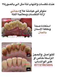 متوفر تنظيف (مجاني) وعلاج للـ لثة! عندك تكلسات وتصبغات بأسنانك؟؟  للحج...