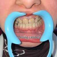 تركيب تجميلي • من أول جلسة • عيادة لؤلؤة بدرة