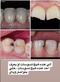 تسوس أسنان • العلاج مجاني • البصرة