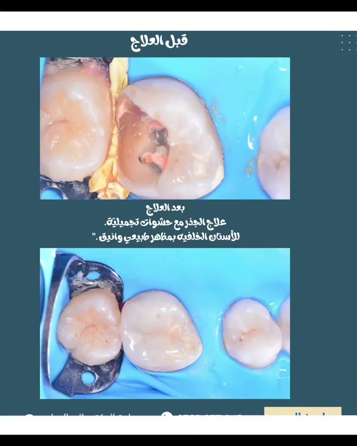 “تم إجراء حشوة جذر وتجميلية للأسنان الخلفية…
 بدقة عالية وراحة تدوم.”

 (عيادة الدكتور أثير حليم الرماحي) 

☎️ للحجز والاستفسار ***********
او مراسلة الصفحة

📍 الموقع: 
الديوانية- قضاء عفك/شارع الأطباء قرب صيدلية أكرم البديري بناية الدكتورة مروة حمود التميمي الطابق الثاني

#ابتسامتك_تستحق_الأفضل
#حشوات_تجميلية_حشوات_جذور_تركيب_اسنان_ثابتة_ومتحركة_تبييض_اسنان_بالليزر_ابتسامة_المشاهير#دكتور_أسنان
#اكسبلور_explore #قضاء_عفك
