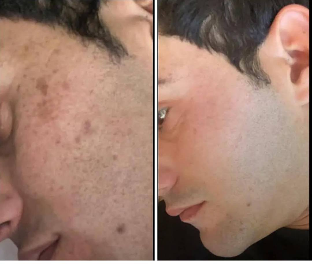 ***********سلام عليكم حبايب بعدكم ممجربين الخلطه العندي. والله العظيم عمره خساره الي ممجربه يشهد الله ورسوله شغله يجنن وعندي عنه تجارب خير من الله وحتى انطيت بيه ضمان استرجاع لانه متئكده منه ومن شغله ونتائجها تحلج كل مشاكل البشره السمرار التصبغ الكلف العنيد الجلح عدم النضاره مواده كله مختصه بهذا الشي والله خساره للماجربه هسه وعندي عنه تجارب خييير من الله الي يحب يدخل خاص وتدللون عيوني. 💓***********
