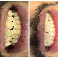 تنظيف الأسنان • تبييض الأسنان • إزالة التكلسات