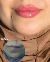 فلر شفة • شفة ناعمة • ذقن أنثوي