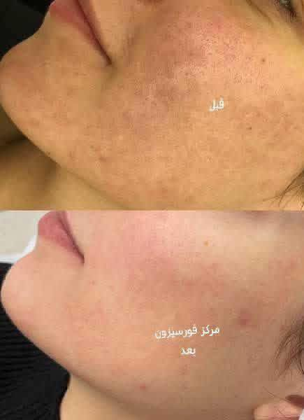 فـورسيزون مقدملكم هالمـرة عرض غير!!😍😍

تنظيـيف بشرة + رموش طرفية 20 الف فقط 
بـدل الـ35 ألف 
شمنتضريِن؟🔥العـرض محدود فقط لكم يوم

للحجز والأستفسار ***********
