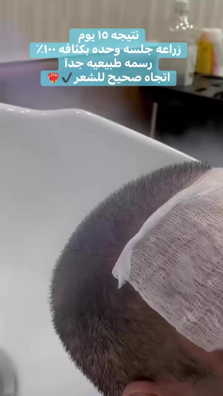 نتيجه ١٥ يوم فقط من اجراء عمليه زراعه الشعر🩺💎 

 ✨ولازم تعرف 
الشغل النظيف إله سعر… 

لأن وراه:::
 
خبرة☑️
دقة☑️
وضمير مهني☑️
لا تقارن نتيجة تعيش وياك سنين
بشغل مستعجل ❌وسعره رخيص
 بس تكلفته عليك أكبر
اختار الصح من البداية… حتى ترتاح للنتيجة للأبد

🔲للحجز والاستفسار
***********

او زورونا بموقع العياده
🔲بغداد المنصور شارع الرواد مقابل مرطبات مشمشه
