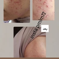 راحة بشرتك في أيدينا زبائننا يحققون نتائج استثنائية في علاج حب الشباب....