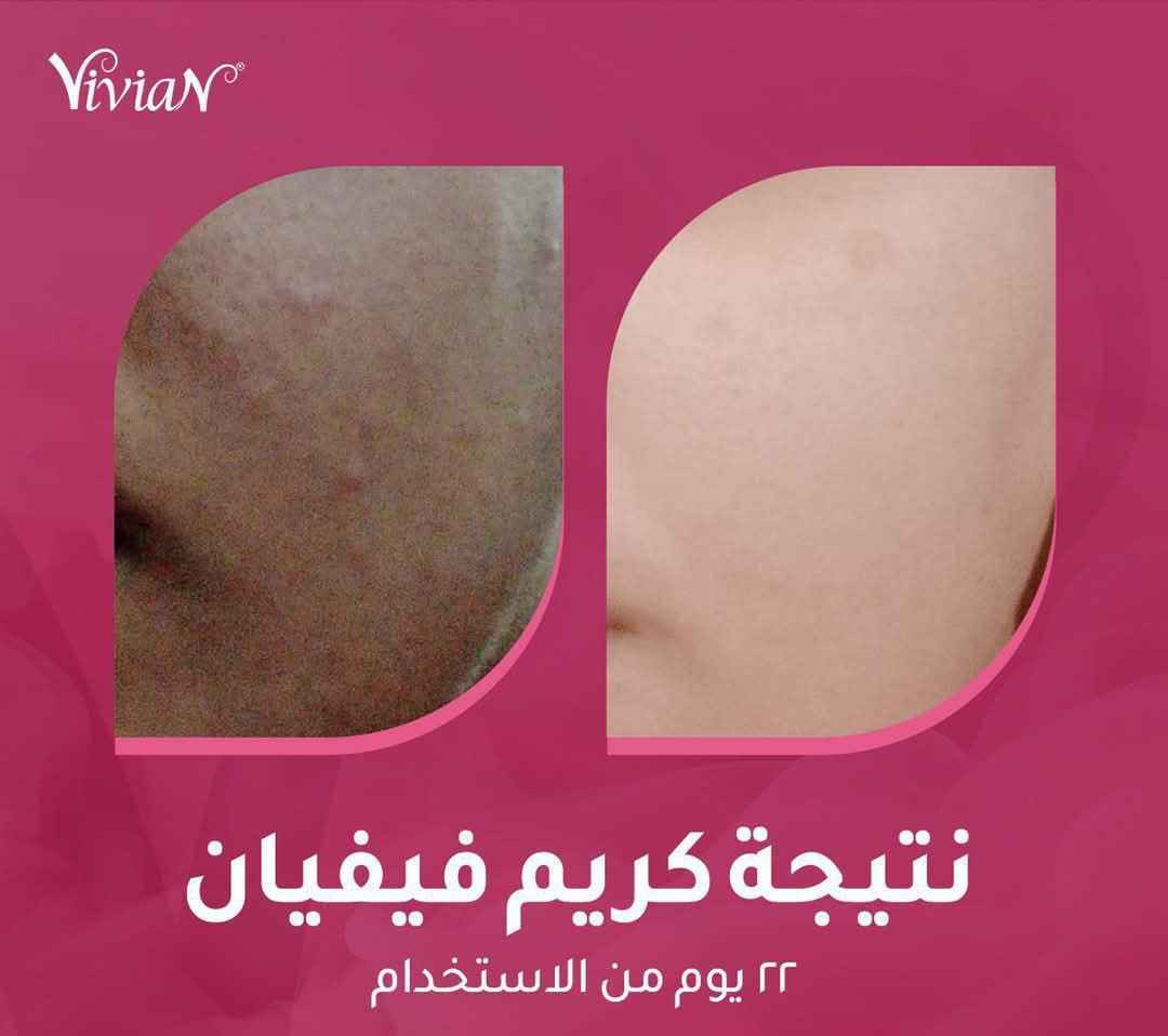 ❄️ احد اهم افضل المنتجات لتبييض البشرة ❄️
.
🟢كريم فيفيان مصنوع من 14 مادة عشبية 🍀 و6 فيتامينات  💊
.
 🎗منتج واحد يساعد علئ حل اهم 5  مشاكل للبشرة 🎗
.
يبيض البشرة - يعالج الكلف - يعالج التصبغات - يعالج الهالات التحت العين - يرطب البشرة وتصبح اكثر نضارة 
.
كريم فيفيان منتج ®️ صنع في كوريا ويعمل بسياسة 🎗 ما بعد البيع كـ  🔁 الاستبدال والاسترجاع  
.
نتيجة الكريم ثابتة ودائمية 🟢 نتائج حقيقية من اول  استخدام 🟢 بدون اثار جانبية اثناء  او بعد ترك الاستخدام  بسبب التركيبة العشبية

👈🏻💌اي استفسار او الحجز👇🏻
 ***********

#التوصيل_لجميع_المحافظات بغداد, العراق
