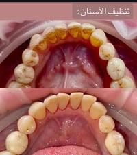 تنظيف اسنان • مجاني • كربلاء