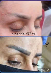 ازالة تاتو حواجب • جلسه اولى • السماوه حي الحسين