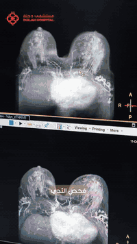 🩷 رنين الثدي… دقّة تشخيصية تصنع الفارق
يُعدّ رنين الثدي  من أدق الفحوصات  عالميًا لتشخيص أورام الثدي لدى النساء 
حصريافي مستشفى دجلة الأهلي – الكوت نوفّر فحص رنين الثدي بأحدث التقنيات، من أجل:
✔️ الكشف المبكر عن أورام الثدي
✔️ متابعة الحالات المشتبه بها بدقة عالية
✔️ التقييم قبل وبعد العلاج
لأن الاطمئنان الحقيقي يبدأ بتشخيص صحيح.
🔹 فحص آمن بدون إشعاع
🔹 كادر طبي متخصص
🔹 أجهزة متطورة
🔹 خصوصية واهتمام بكل حالة
✨ الكشف المبكر… خطوة بسيطة قد تُنقذ حياتكِ
#صحة_المرأة
#رنين_الثدي
#الكشف_المبكر
#سرطان_الثدي
#مستشفى_دجلة_الأهلي
#دجلة_عالم_طبي
📍 العنوان: الكوت – شارع سدة الكوت
قسم الرنين والمفراس: ***********
المستشفى: *********** | ***********
الرقم الفوري: 7955
