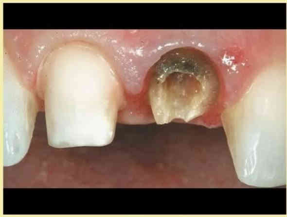 الي عنده حشوة او قلع او تنظيف اسنان مثل ماموضح بالصور وحاب يعالجهن يتواصل ويانه بالخاص العلاج مجاني تحت إشراف أطباء اختصاص 
العنوان : الحلة ،شارع أربعين،مجاور صيدلية سلامتك

‭٠ ٧٨٦ ٤٦٨ ١٦١٦‬الحجز واتساب
