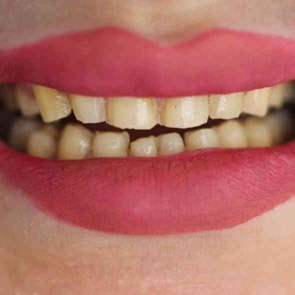 مركز اوتار كلنك لطب الأسنان والتجميل 
ابتسامة هوليود بتفاصيل تتناسب مع لون البشره 
الابتسامة الصح بالمكان الصح 
العنوان الشموخ خلف مكتب الحنين للعقار داخل الفرع 📍 
للحجز ***********
