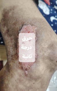ضماد حرق درجة ثانية • متابعة منزلية • مجمع الاميرات الثاني