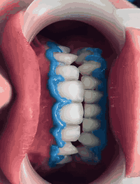 🔥 عرض خاص لفترة محدودة 🔥
💎 خصم 40٪؜ على تبييض الأسنان
🎁 تنظيف أسنان مجاني ويا العرض

لا تضيع الفرصة 🌸
احجز هسه وخلي ابتسامتك تحچي عنك ✨

📞 للحجز والاستفسار:
*********** (اتصال / واتساب)
