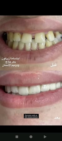 عيادات إبرو • عروض وتخفيضات • طب الاسنان تجميل