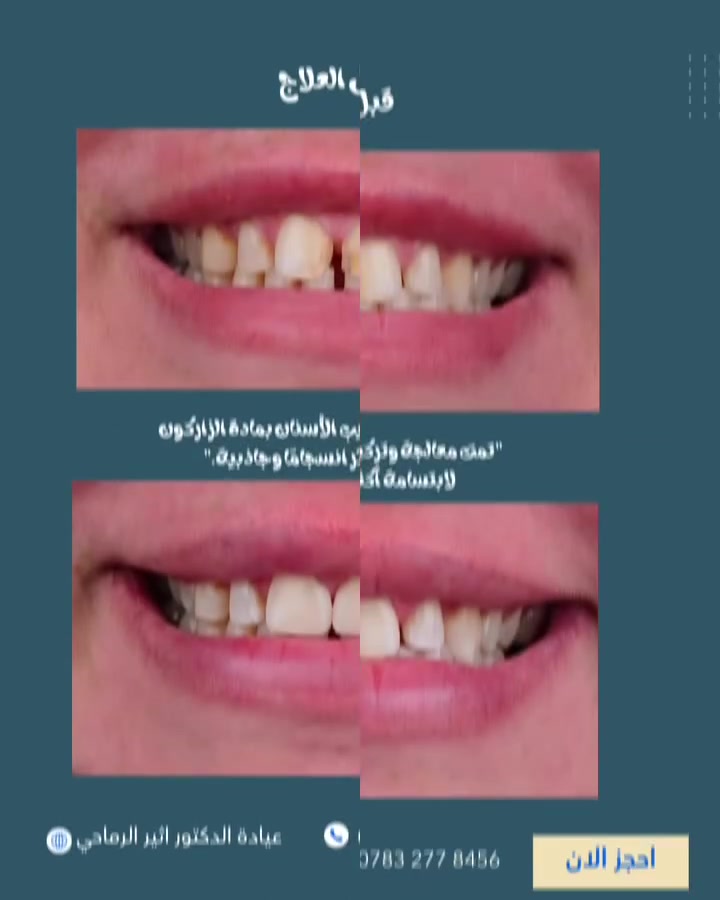 بتركيبات الزيركون، تعود الابتسامة بتفاصيل أجمل 😍
ولمسة أكثر فخامة.”😌

 (عيادة الدكتور أثير حليم الرماحي)

☎️ للحجز والاستفسار ***********
او مراسلة الصفحة

📍 الموقع :
الديوانية- قضاء عفك/شارع الأطباء قرب صيدلية أكرم البديري بناية الدكتورة مروة حمود التميمي الطابق الثاني

#تركيبات_أسنان_زاركون
#ابتسامتك_تستحق_الأفضل
#اكسبلورexplore
#قضاء_عفك
#دكتور_أسنان
