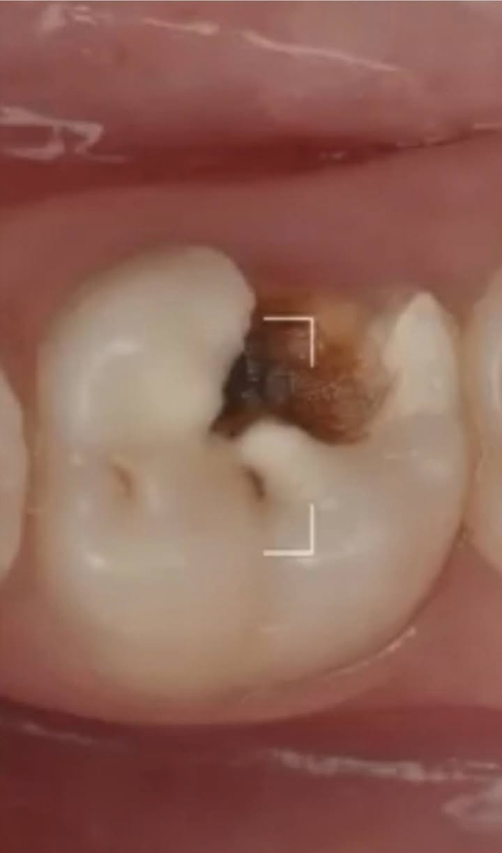 مجاناااا
الي عنده هيجي تسوس او كسر باسنانه مثل الي بالصورة ويريد يعالجه بحشوة ضوئية يتواصل ويايه خاص اويتصل على الرقم ***********
شارع 40 مجاور صيدلية سلامتك
(العلاج مجانا)
