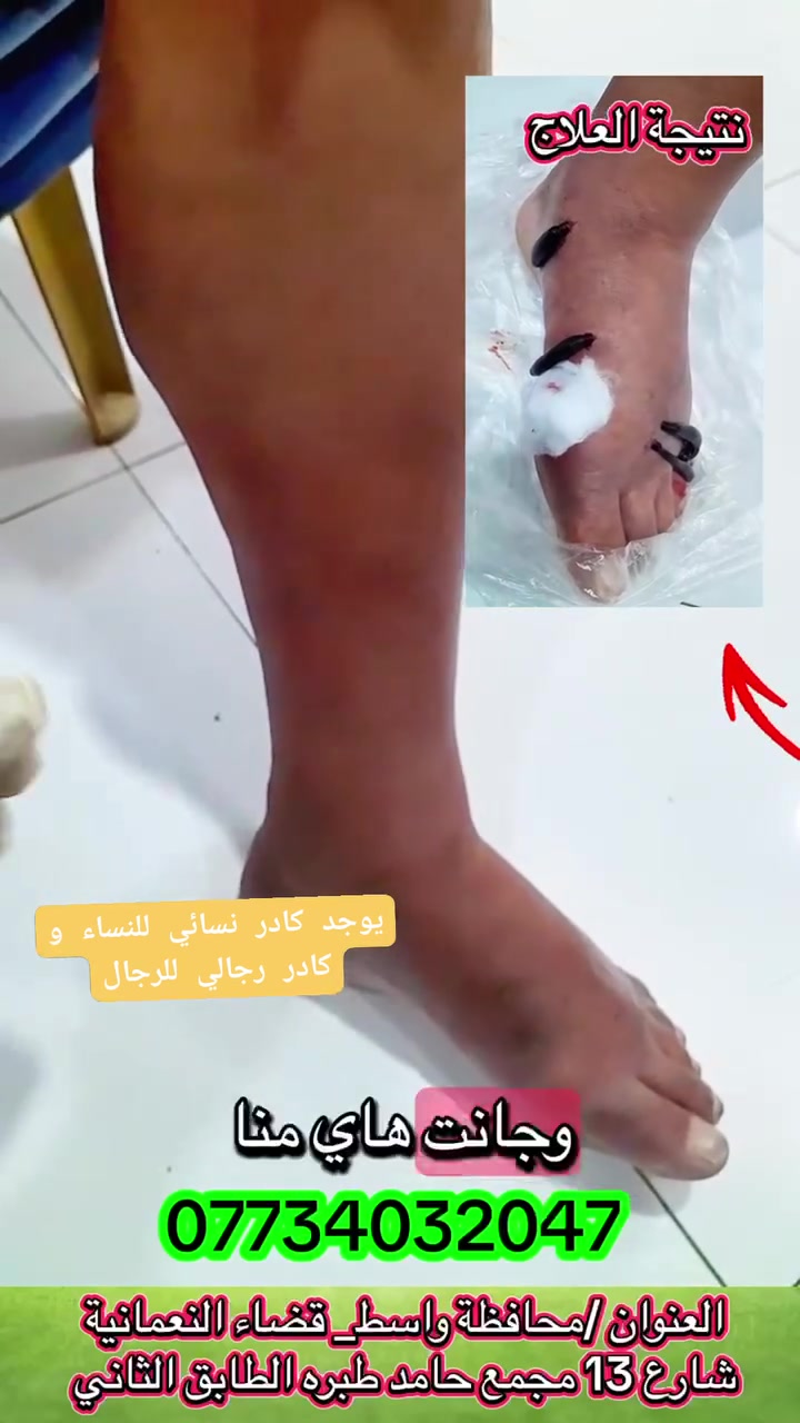 الحجامه النسائية والطب البديل
🩸 فوائد معالجة تخثر الدم بالعلق الطبي:
▪️ يساعد على تنشيط الدورة الدموية وتحسين جريان الدم
▪️ يخفف من حالات التخثر والتجمعات الدموية
▪️ يقلل الالتهاب والاحتقان في المناطق المصابة
▪️ يساعد على إيصال الأوكسجين للأنسجة بشكل أفضل
▪️ يخفف الألم والتشنجات العضلية
▪️ يُستخدم ضمن الطب البديل بإشراف مختص للحالات المناسبة
العلاج بالعلق الطبي من الطرق القديمة المعروفة، ويحتوي لعاب العلق على مواد تساعد على سيولة الدم وتحسين التروية الدموية. 🌿
يوجد كادر نسائي للنساء و كادر رجالي للرجال 
#العلق_الطبي
#تخثر_الدم
#الطب_البديل
#الحجامة
#العلاج_الطبيعي
#تنشيط_الدورة_الدموية
#علاج_التخثر
#الصحة
#علاج_بالعلق
#ابو_علي_للطب_البديل
 #الجميع 
 #متابعين 
 #اشارة 
 #الكل
 @أبرز المعجبين


**إذا كنت صاحب هذا الإعلان وتريد حذفه لأي سبب، رجاءا أرسل رسالة إلى الدعم الفني**