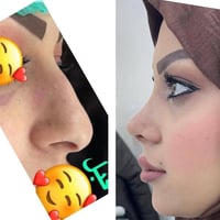 تجميل أنف • تخدير موضعي • مركز المنصور