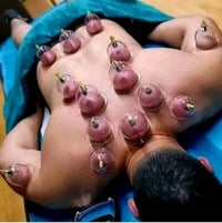 ♦️ التنويع في مواضع الحجامة … سرّ النتائج الأفضل ♦️ ليست الحجامة موضعً...