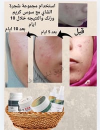 نتيجة حقيقية • خلال ١٠ أيام • انتي اكنة