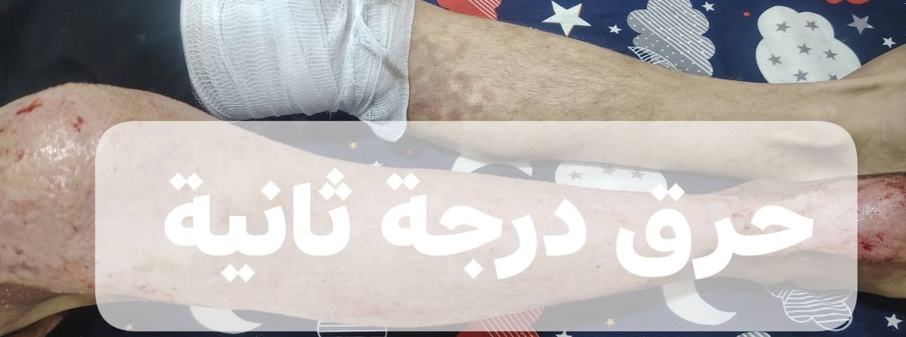 #ضماد_حرق_درجة_ثانية
يوجد لدى عيادتنا كادر متخصص لعلاج و متابعة حالة الحرق من اول يوم إلى حد اكتساب الشفاء التام و يكون الضماد و المتابعة منزلية لا تحتاج إلى زيارة العيادة او مركز الحروق
نختصر عليك الوقت و الجهد و التكلفة

للتواصل
*********** واتساب
*********** اتصال

الله يحفظكم من كل سوء 🤍

 الصور👇 من متابعتنا لشخص محترق بالغاز أثناء عمله في المطعم
يسكن في مجمع الاميرات الثاني
