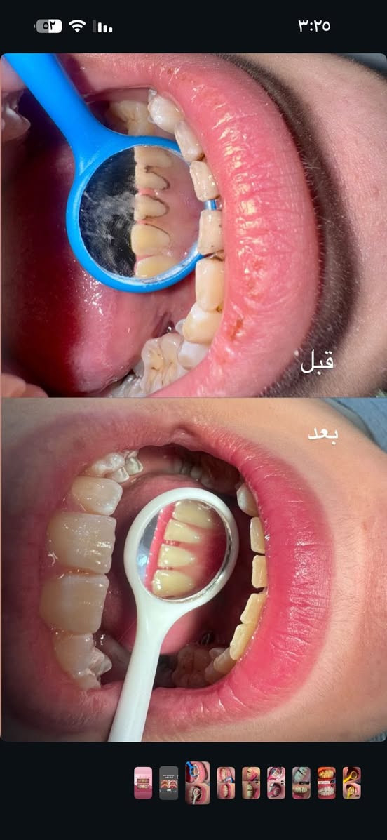⚠️اي شخص محتاج تنظيف وتبييض للأسنان تواصل معي على الرقم 
/واتساب***********

📍الموقع: عيادات جامعة اهل البيت /الحر الصغير /قرب مدينة العاب النوارس

