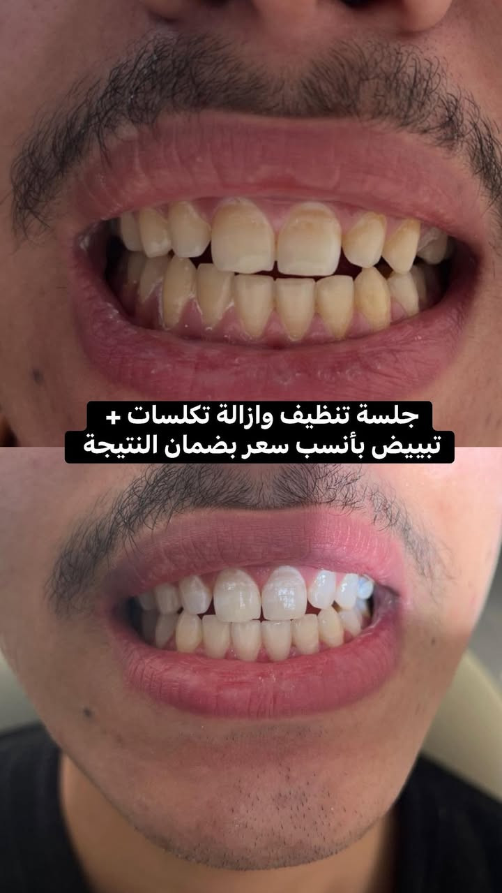 إذا بعدك تخاف من جلسات تنظيف الأسنان وتتوتر من الأدوات 😅

الحل يمنا ويا جهاز Air Prophy ✨

جهاز حديث ينظف الأسنان ويشيل التصبغات والترسبات بلطف عن طريق المي والبودر، حتى يعطيك إحساس بالنظافة واللمعان من أول جلسة.

🔥 والعرض مستمر بـ 15 ألف دينار فقط 🔥

شنو منتظر؟
احجز موعدك وجرب الفرق بنفسك، وخلي ابتسامتك أنظف وأجمل وريحة نفسك منعشة 😍

مو شخص واحد يهتم بيك، عدنا كادر متكامل ومتخصص بمختلف الاختصاصات حتى نقدم أفضل خدمة إلكم ❤️

🕓 الدوام يومياً من الساعة 4 عصراً إلى 9 مساءً

📍 الفحامة – شارع مركز الشرطة – مجاور عيادة الحكيم التمريضية

📞 ***********

✨  ابتسامتك تستاهل الأفضل… وبعيادتنا احنا  نقدملك الأفضل
