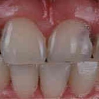 الناصريه • حشوات اسنان • علاج مجاني